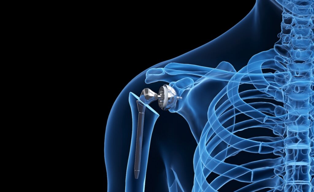 Shoulder replacment